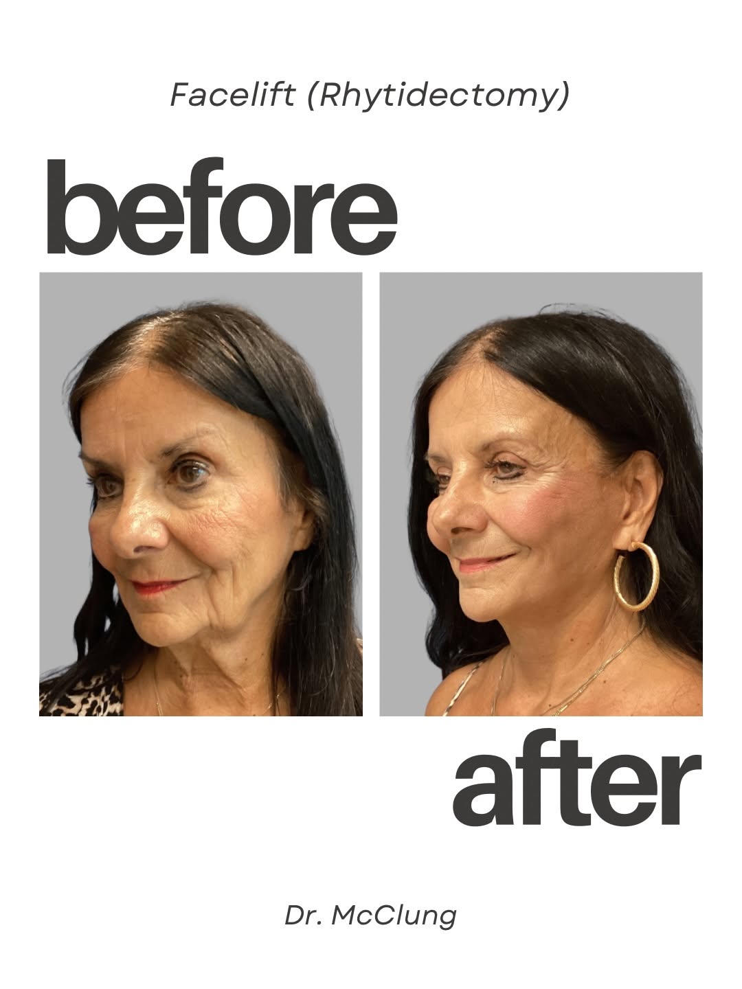 Instagram post by Dr. Mark W. McClung: A refreshed appearance that still looks like you. ✨ This facelift (rhytidectomy) result highlights improved definition through the lower fac…