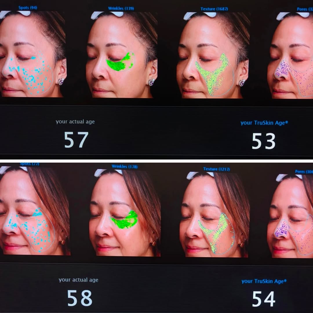 Instagram post by Dr. Marlene Welch: I had my 2025 Visia Skin Analysis today with @brittbates_aesthetics. The Visia evaluates wrinkles, spots, pores, texture, and UV damage. My …