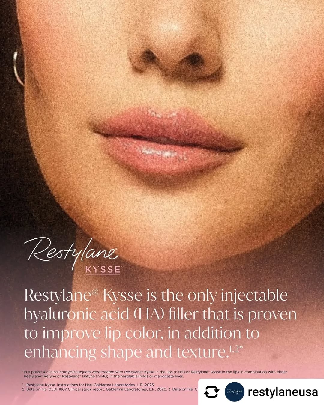 Instagram post by Dr. Marlene Welch: @restylaneusa Restylane Kysse is the only injectable hyaluronic acid (HA) filler that is proven to improve lip color, in addition to enhanci…