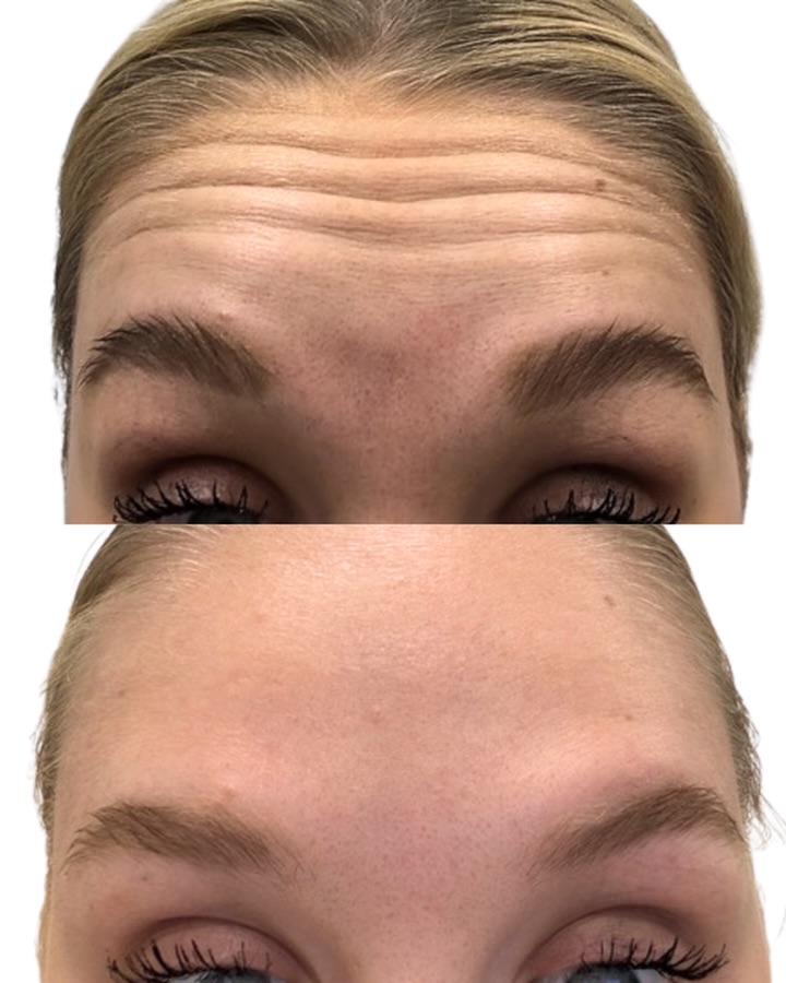 Instagram post by Dr. Marta I. Rendon: Smooth forehead, still looks like you. ✨ Forehead lines softened with Botox by Ebu Scohy, PA-C. Natural, refreshed results that don’t read a…