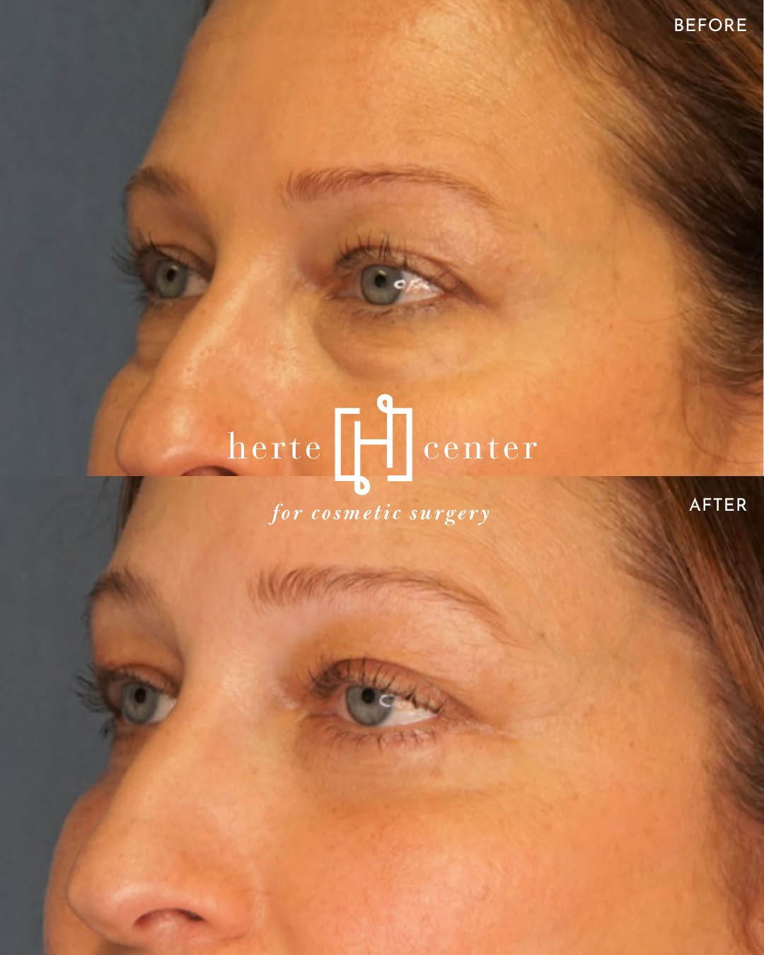 Instagram post by Dr. Mary C. Herte: The delicate skin around your eyes is often one of the first places to show signs of aging. 👁️ Blepharoplasty can address excess upper eyel…
