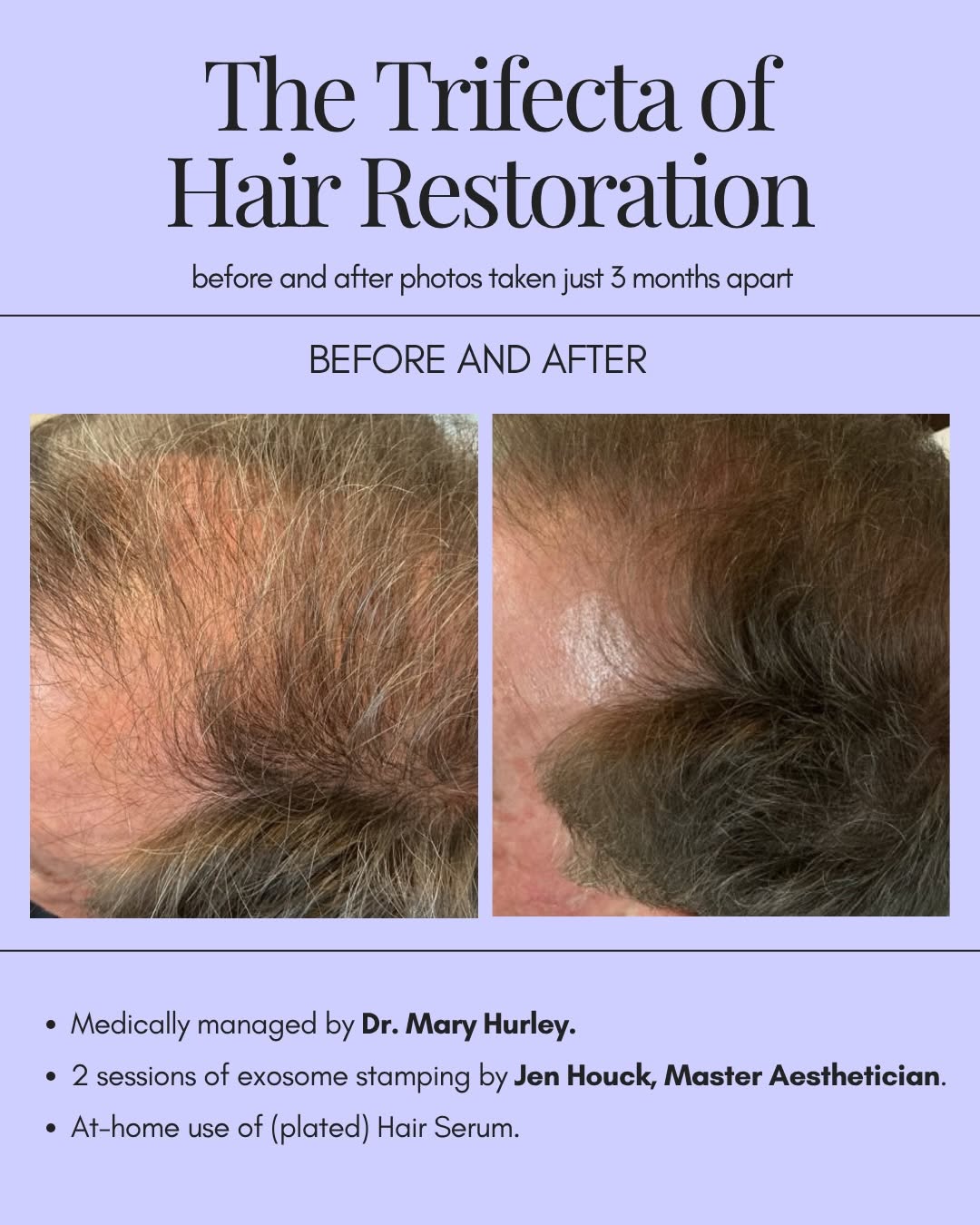 Instagram post by Dr. Mary E. Hurley: June is Men’s Health Month, and taking care of your health includes your hair. These results were achieved with medication management by Dr.…