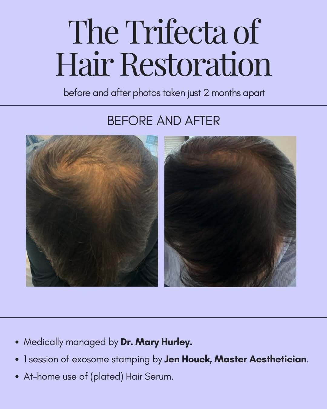 Instagram post by Dr. Mary E. Hurley: Hair restoration is a team effort—and these results speak for themselves. These before-and-after photos were taken just 2 months apart after…