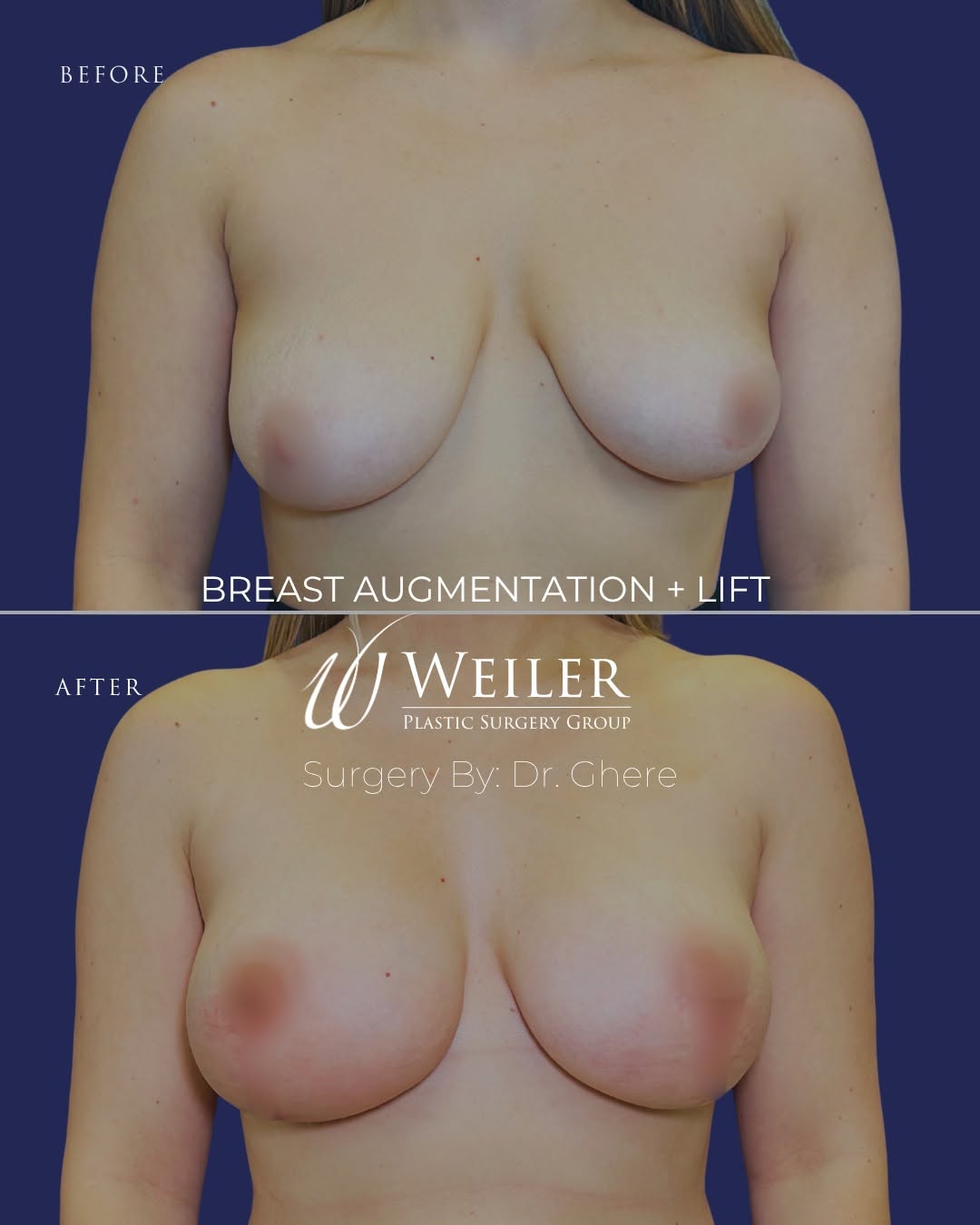 Instagram post by Dr. Mary Ghere: BEFORE AND AFTER BY DR. GHERE 🥼 Take a look at this stunning before & after featuring a breast augmentation with lift by Dr. Ghere, using M…