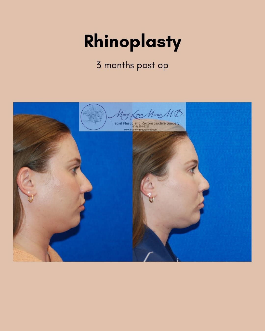 Instagram post by Dr. Mary Lynn Moran: This beautiful patient is only 3 months post-rhinoplasty and already loving her results! ✨ As the swelling continues to go down, her results…