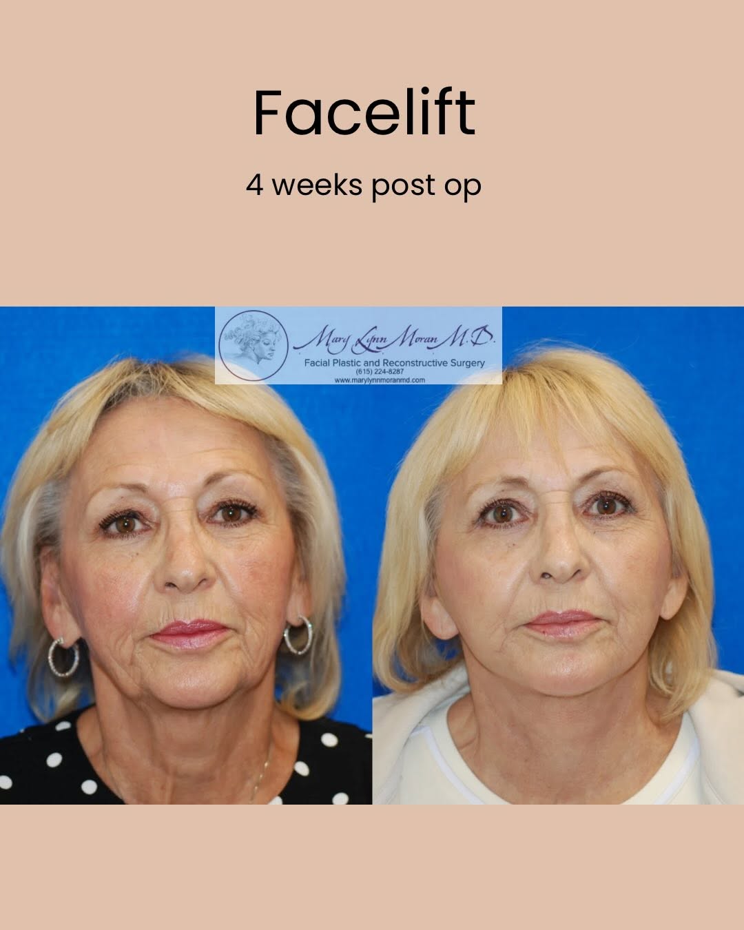 Instagram post by Dr. Mary Lynn Moran: This beautiful patient is only 4 weeks post-op and already glowing. Such a beautiful, natural transformation. It’s our patients time to shin…