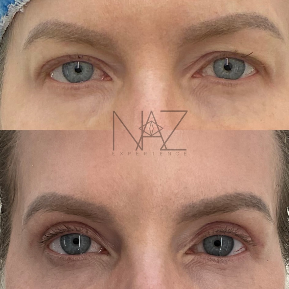Instagram post by Dr. Maryam Nazemzadeh: ✨ 3 months post upper blepharoplasty with fat sculpting ✨ By 3 months, upper eyelid incisions have typically healed beautifully and continue…