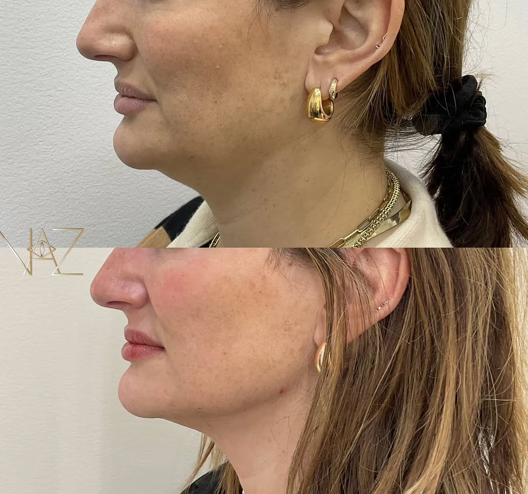 Instagram post by Dr. Maryam Nazemzadeh: 🔥 Proof that subtle changes make the biggest impact. 3 SkinTyte treatments in a course of 6 weeks. A sharper jawline, tighter skin, and imp…