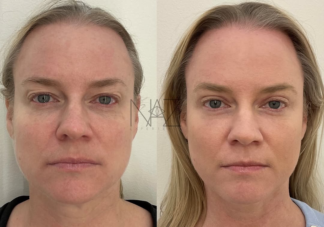 Instagram post by Dr. Maryam Nazemzadeh: ✨ 2 months after upper eyelid blepharoplasty with fat sculpting ✨ As always, preservation of natural anatomy is key. Here’s proof that rejuv…