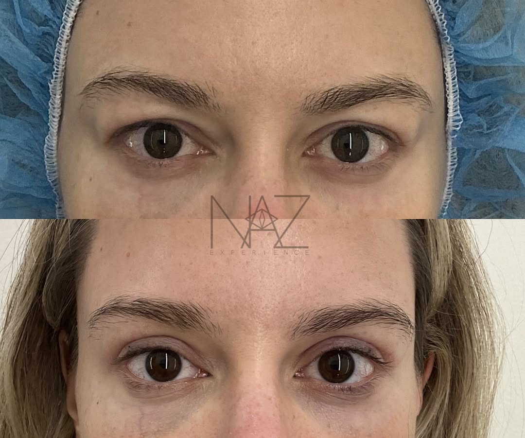 Instagram post by Dr. Maryam Nazemzadeh: Upper Blepharoplasty + Lacrimal Gland Repositioning 👁️ This beautiful patient is 2.5 months out from upper eyelid blepharoplasty with lacri…
