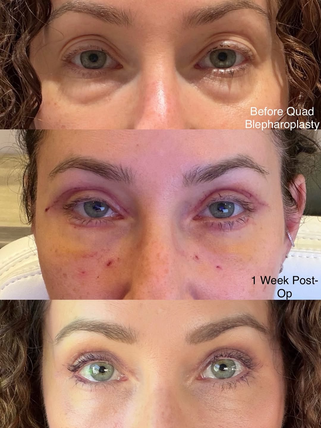 Instagram post by Dr. Maryam Nazemzadeh: Our beautiful out-of-town patient documented and shared her own healing journey with us. 🤍 She underwent a quad blepharoplasty - upper and …
