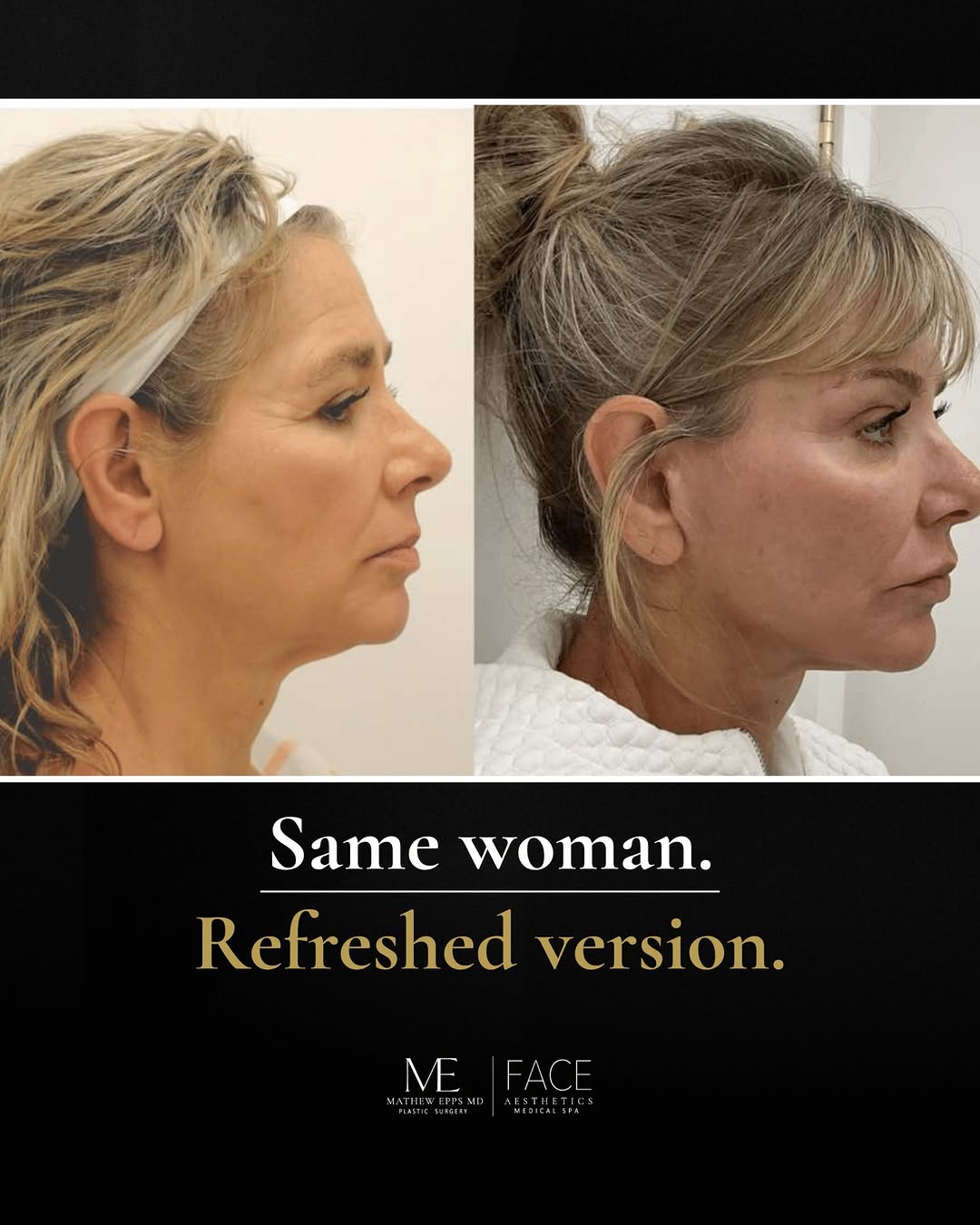 Instagram post by Dr. Mathew Epps: The goal was never to make her look different. It was about enhancing what was already there: more definition, better balance, and a refresh…