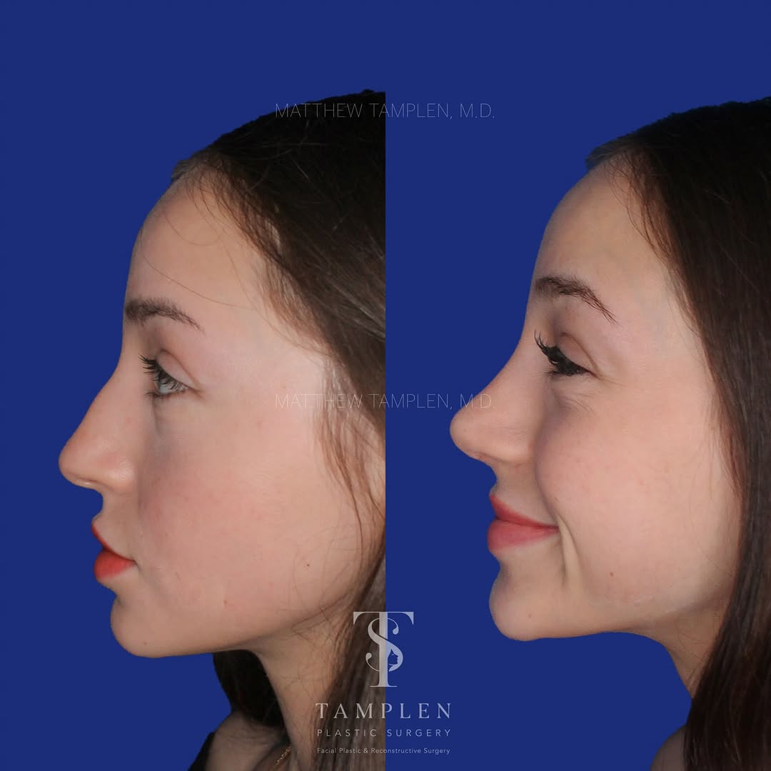 Instagram post by Dr. Matthew Tamplen: This amazing patient came to us bothered by her dorsal hump and a drooping tip. Her goal was simple: a smooth, natural slope and a refined t…