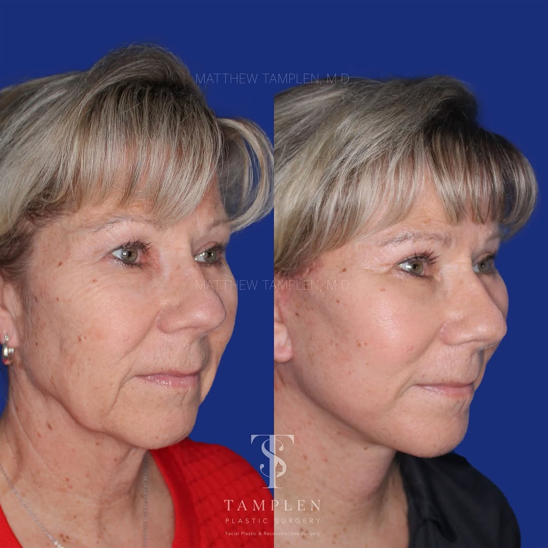 Instagram post by Dr. Matthew Tamplen: Just 6 weeks after a Deep Plane Facelift ✨ Already seeing a beautiful, natural transformation at this early stage of healing. This patient u…
