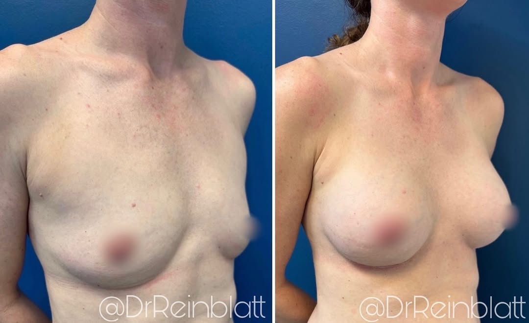 Instagram post by Dr. Maura Reinblatt: Four Weeks After Breast Augmentation ✨ At just four weeks, my patient is already looking great and has had a smooth recovery! ✨ Fuller shape…