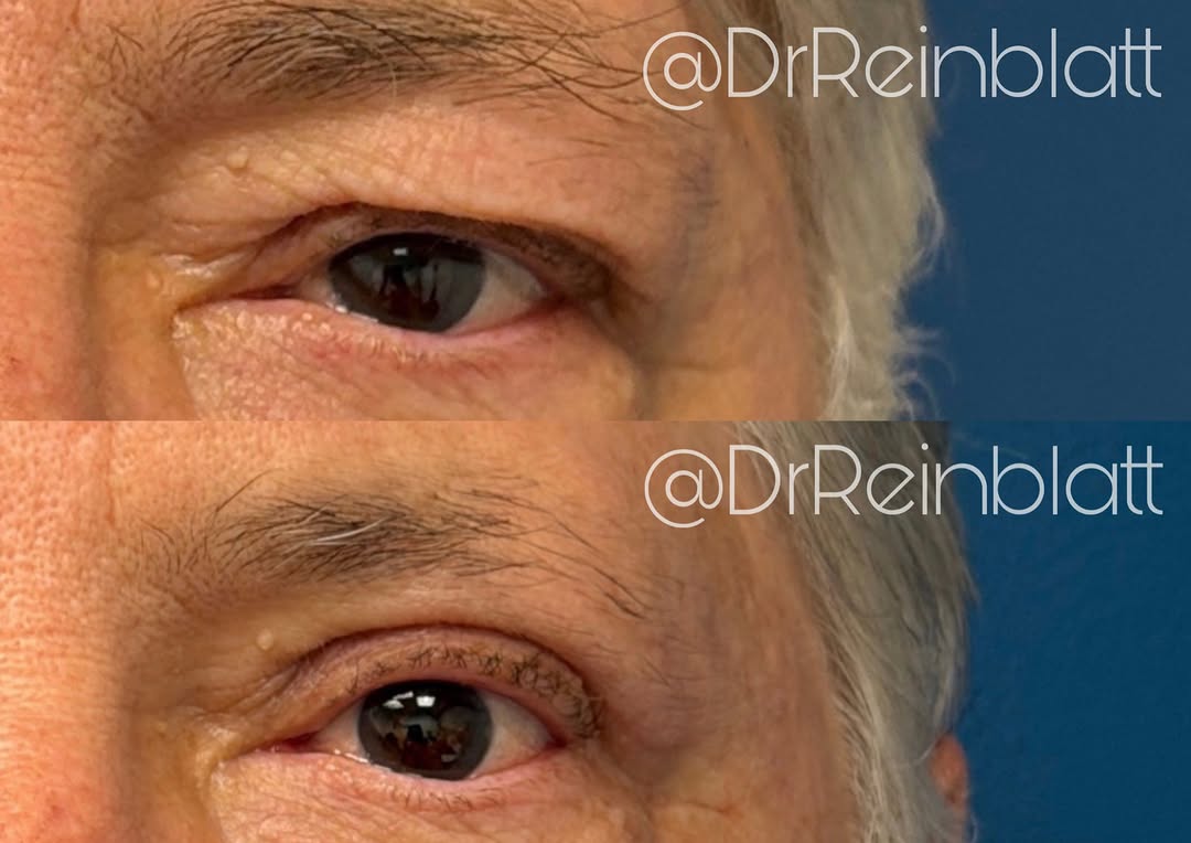 Instagram post by Dr. Maura Reinblatt: Ten Weeks After Blepharoplasty 👁️ My patient was bothered by excess skin on his upper eyelids. Ten weeks after surgery, he’s looking refres…