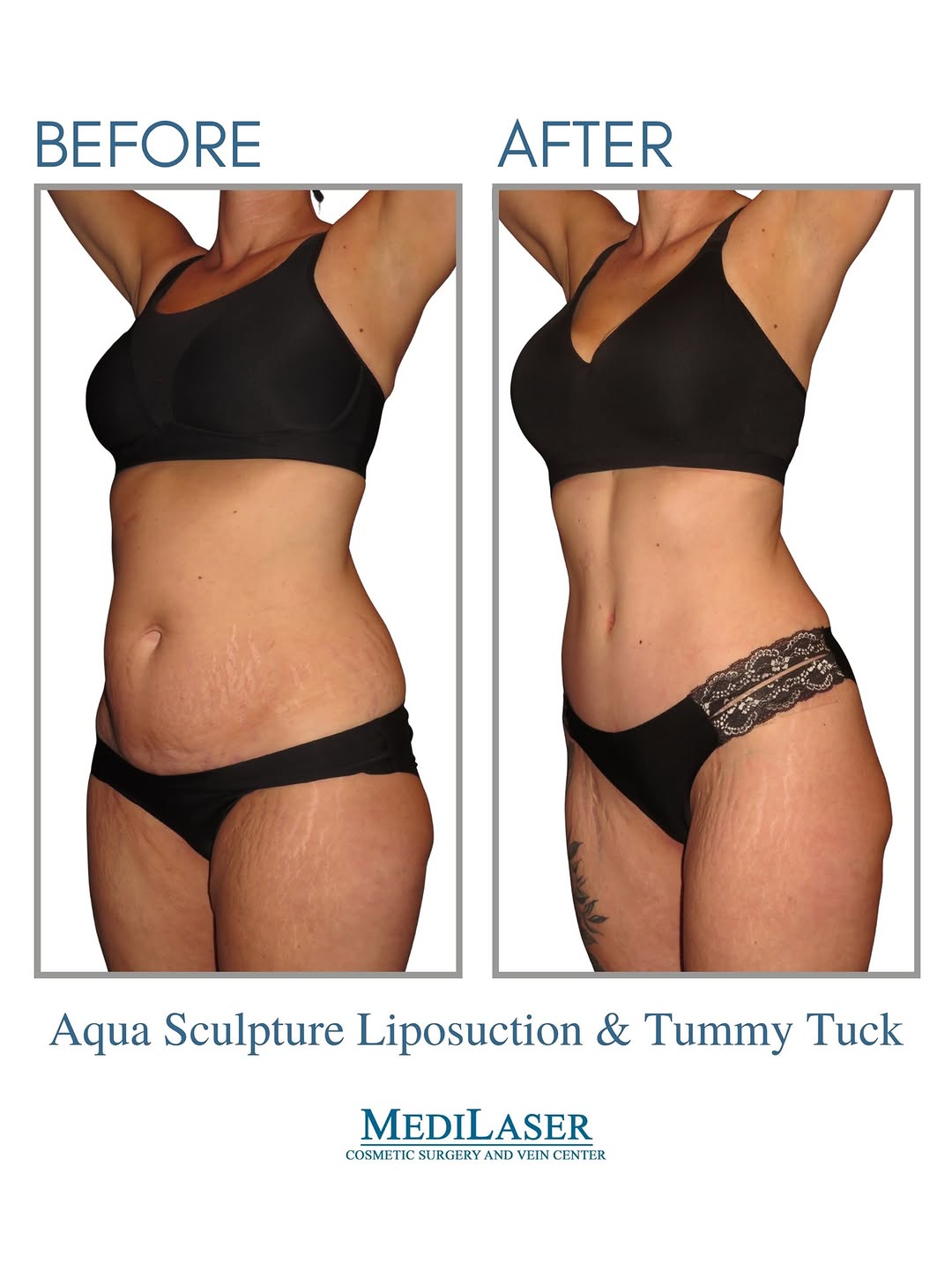 Instagram post by Dr. Mauricio Giraldo: 👉 Are you Having trouble achieving your dream body? You’re not alone. 😍 A Tummy Tuck with Liposuction from Frisco Cosmetic Surgeon Maurici…