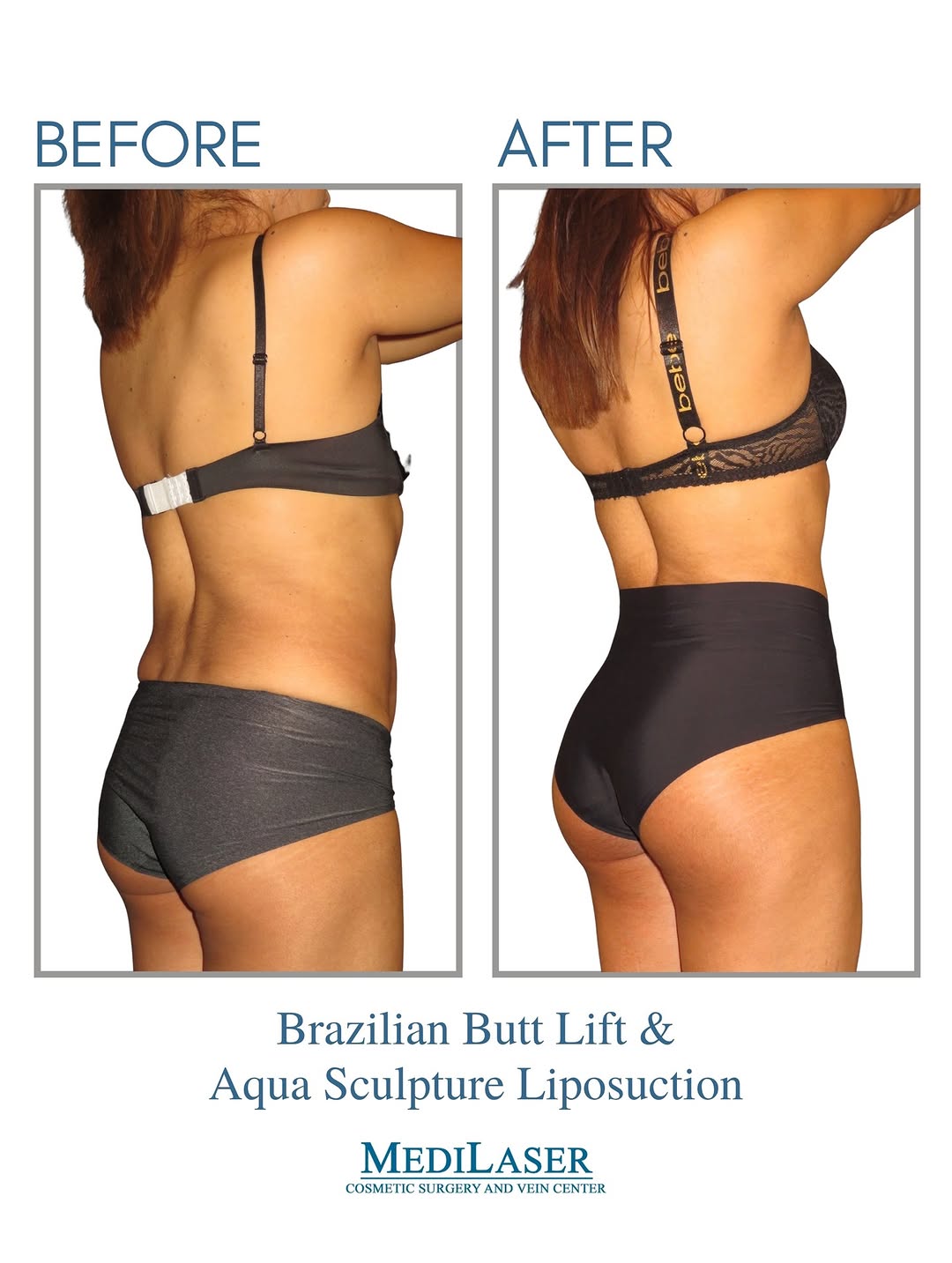 Instagram post by Dr. Mauricio Giraldo: 🍑✨ Before & After Transformation! ✨🍑 💪 This is what confidence looks like! Our patient achieved stunning, natural-looking curves with a B…