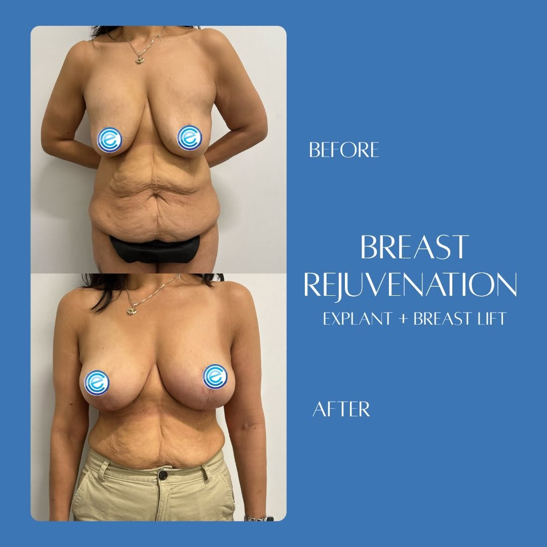 Instagram post by Dr. Mazen Bedri: Explant + Breast Lift + Fat Grafting + Arm Lift ✨ This patient underwent implant removal, a breast lift with fat grafting, and brachioplasty…