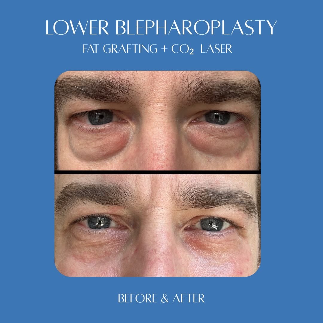 Instagram post by Dr. Mazen Bedri: The best results are the ones no one can quite put their finger on 🧐 For this patient, @drdanmazz combined a lower blepharoplasty, fat graf…