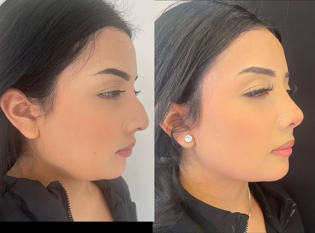 Instagram post by Dr. Meaghan Noud: Thank you to this wonderful patient who allowed me to post photos of her before and after her septorhinoplasty. This surgery was a combined …