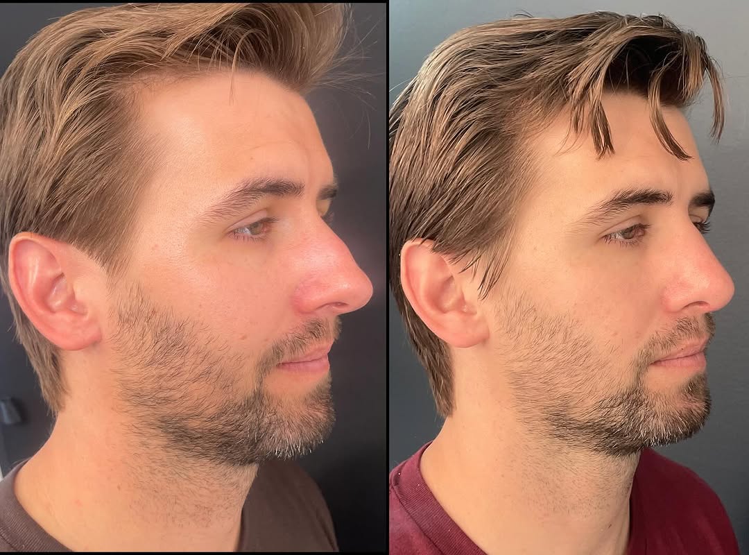 Instagram post by Dr. Meaghan Noud: This patient graciously consented to us posting his before and 3 month after functional and cosmetic rhinoplasty photos. He reports signific…