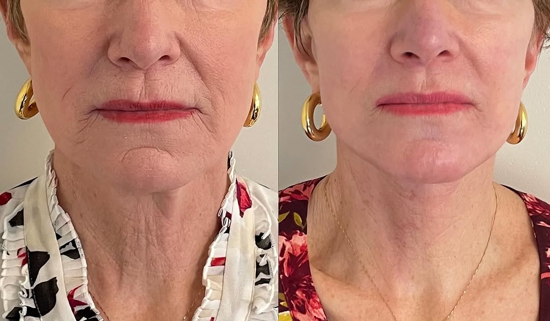 Instagram post by Dr. Meaghan Noud: Thank you to this patient who allowed us to share her 6wk post op photos after deep plane face and neck lift surgery and chemical peel. This…