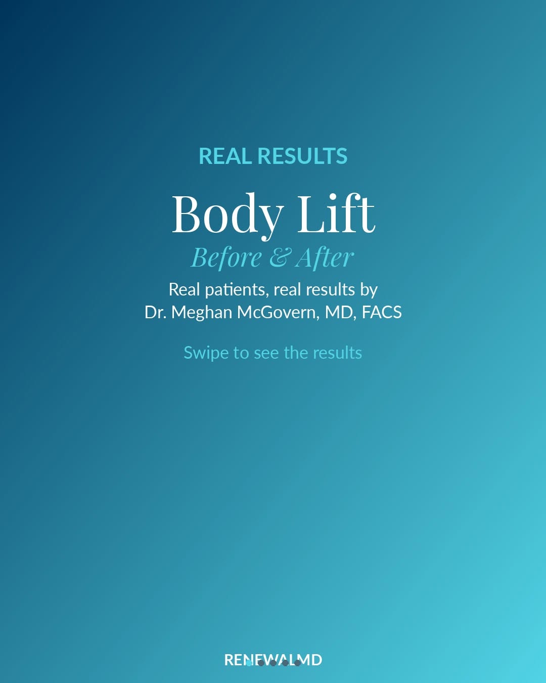 Instagram post by Dr. Meghan K. McGovern: Real patients. Real results. Real transformation. ✨ Swipe to see these body lift results by Dr. Meghan McGovern — excess skin removed and th…