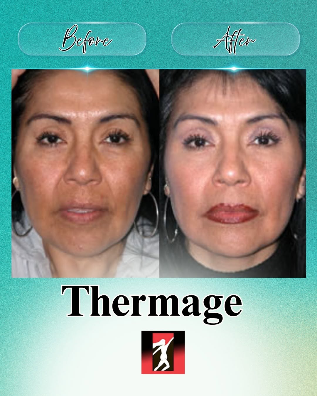 Instagram post by Dr. Mehrdad Hassid: See the difference just 1 month after Thermage®. This non-invasive treatment can help improve the appearance of skin for a smoother, more re…