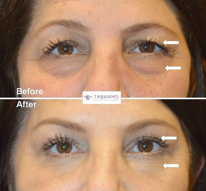 Instagram post by Dr. Mehryar (Ray) Taban: #eyesbytaban #eyetransformation . 65+ year old woman, with tired hooded saggy upper eyelids and under eye bags & dark circles, underwent #up…
