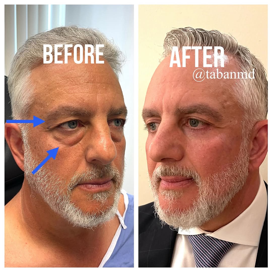 Instagram post by Dr. Mehryar (Ray) Taban: #eyesbytaban MALE LOWER + UPPER BLEPHAROPLASTY: Middle age gentleman, with tired/older appearing eyes, underwent #lowerblepharoplasty and ma…