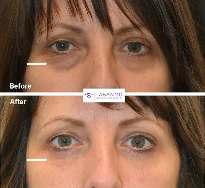 Instagram post by Dr. Mehryar (Ray) Taban: #eyesbytaban LOWER BLEPHAROPLASTY: Middle age woman #lowerblepharoplasty (repositioning of the eye fat bags to the hollow tear trough area p…