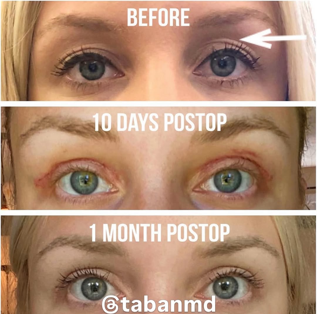 Instagram post by Dr. Mehryar (Ray) Taban: #eyesbytaban Healing after revision Upper Blepharoplasty plus filler. Note youthful natural results with fast recovery. Most patients look p…