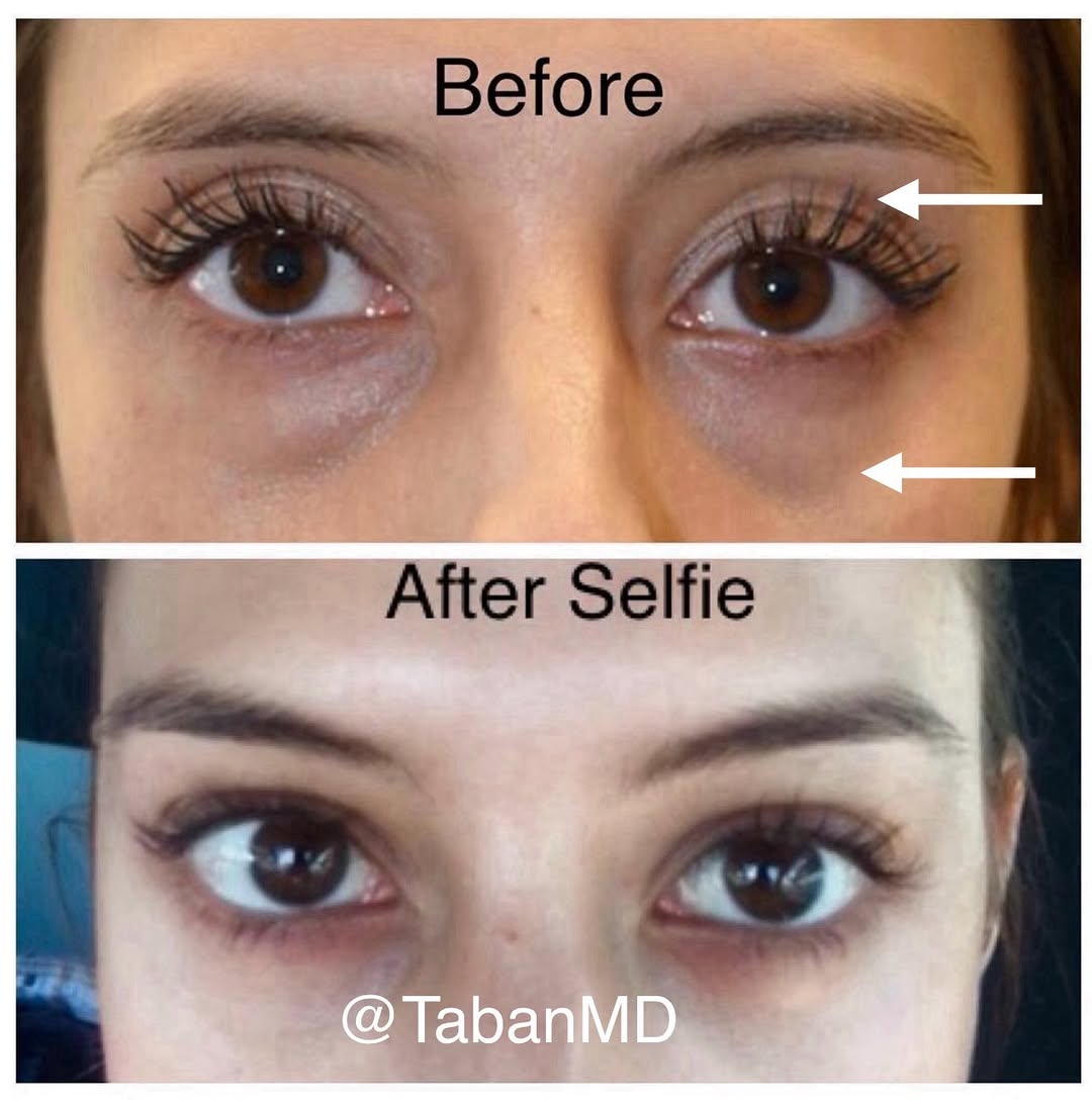 Instagram post by Dr. Mehryar (Ray) Taban: #eyesbytaban Young woman underwent scarless #lowerblepharoplasty (transconjunctival technique with eye fat bags repositioning) and upper eye…