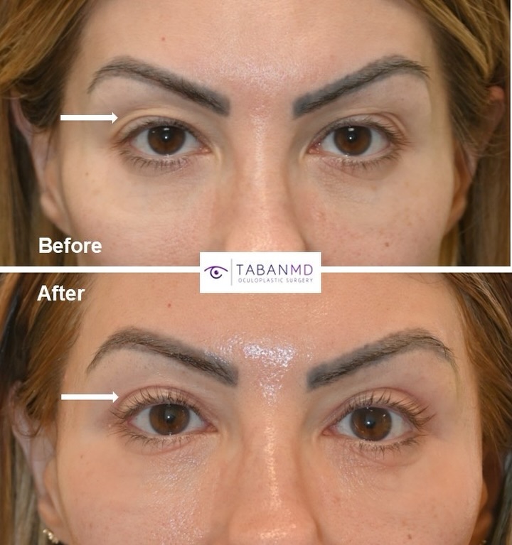 Instagram post by Dr. Mehryar (Ray) Taban: #eyesbytaban UPPER BLEPHAROPLASTY: Middle age woman with tired hooded saggy upper eyelids, underwent customized #upperblepharoplasty #eyelid…