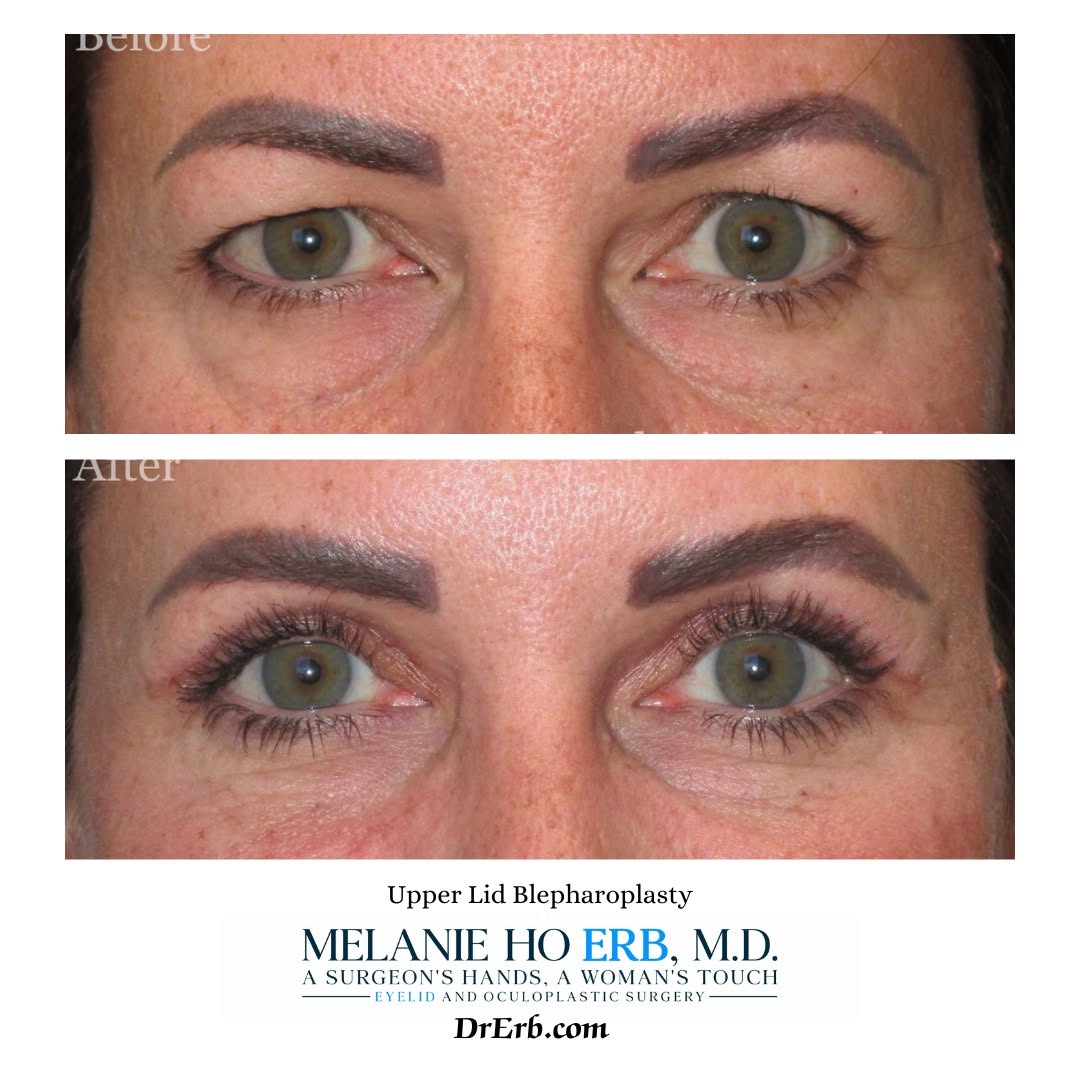 Instagram post by Dr. Melanie Ho Erb: This lovely patient wanted to improve upper eyelid symmetry and heaviness. Upper lid blepharoplasty done by Dr Erb.