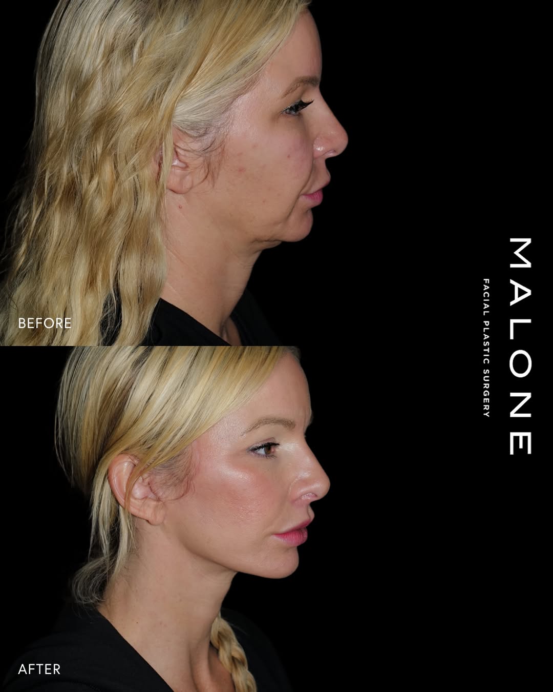Instagram post by Dr. Melanie Malone: Our lovely patient in her mid-40s looks beautifully refreshed after her deep plane face and neck lift. This procedure addressed the drooping…