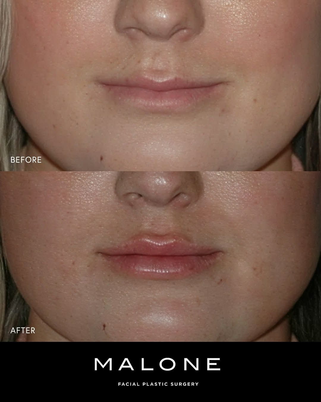 Instagram post by Dr. Melanie Malone: Soft, natural volume that still looks like her lips. This is what balanced lip filler looks like, fuller without losing shape or symmetry 🌟