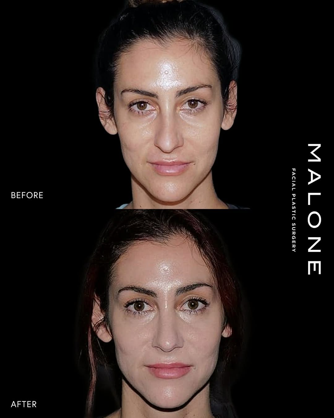 Instagram post by Dr. Melanie Malone: We are so happy to see our closed rhinoplasty patient back. She underwent a closed, or scarless, rhinoplasty to lift the nasal tip and smoot…