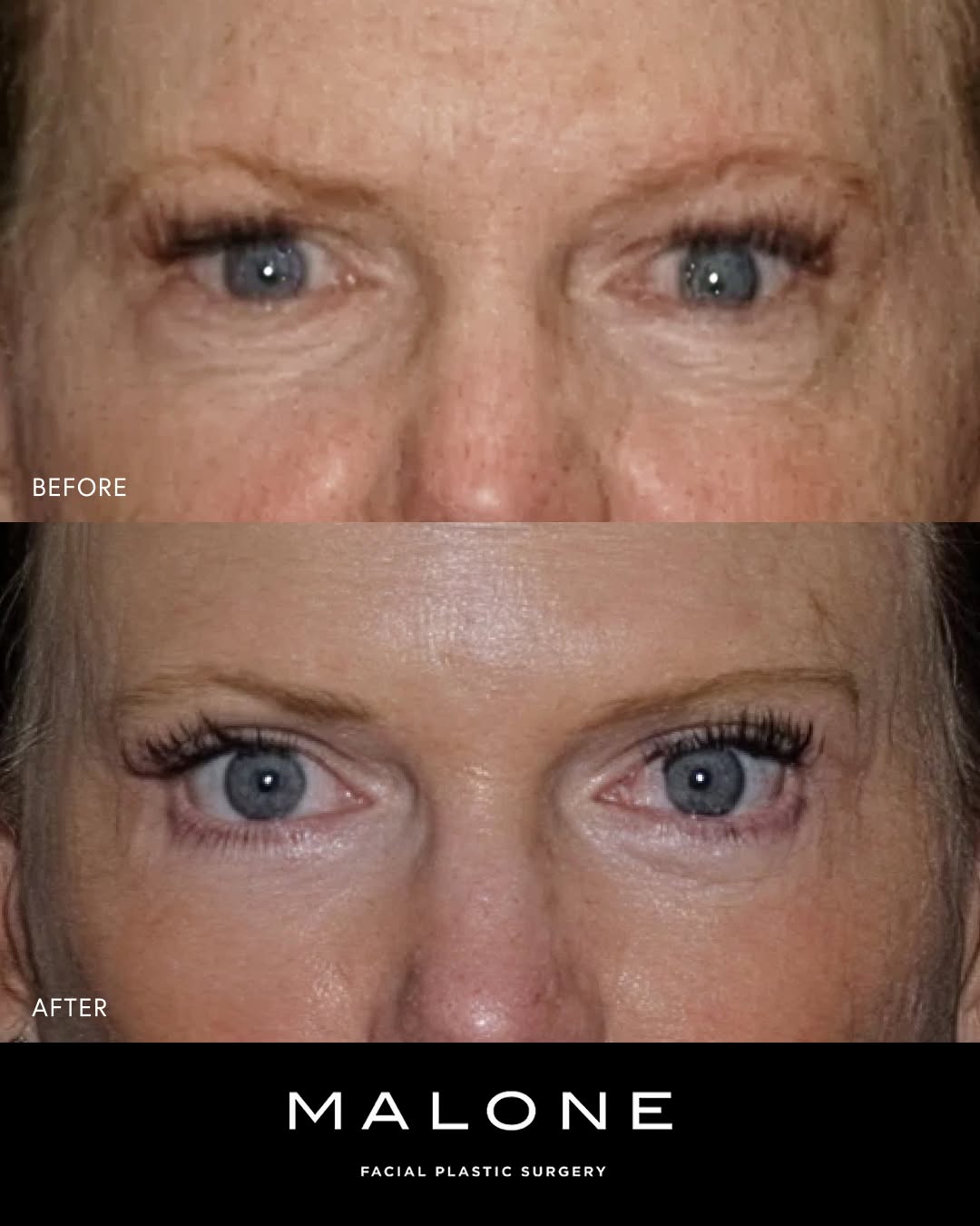 Instagram post by Dr. Melanie Malone: We are so happy to see our gorgeous patient back with her naturally beautiful results. She underwent upper and lower eyelid lift to create a…