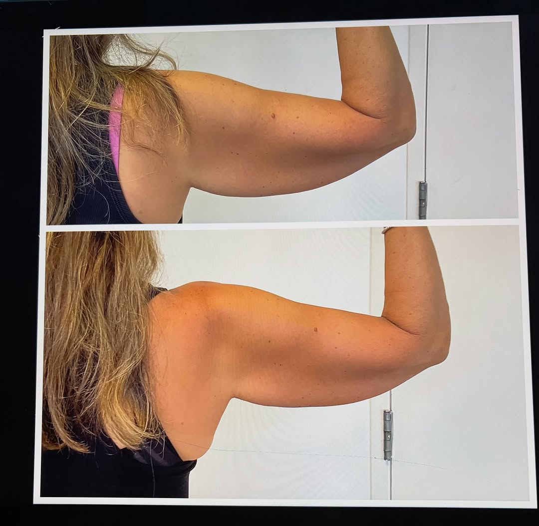 Instagram post by Dr. Melina Jampolis: 1 Month CoolSculpting Follow-Up Today marks one month since this patient’s first CoolSculpting treatment! While visible changes can begin to…