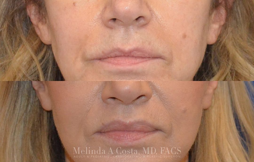 Instagram post by Dr. Melinda A. Costa: 5 months post op. Dr. Costa performed an in office lip lift. This procedure consists of removing and tightening the skin right before the ba…