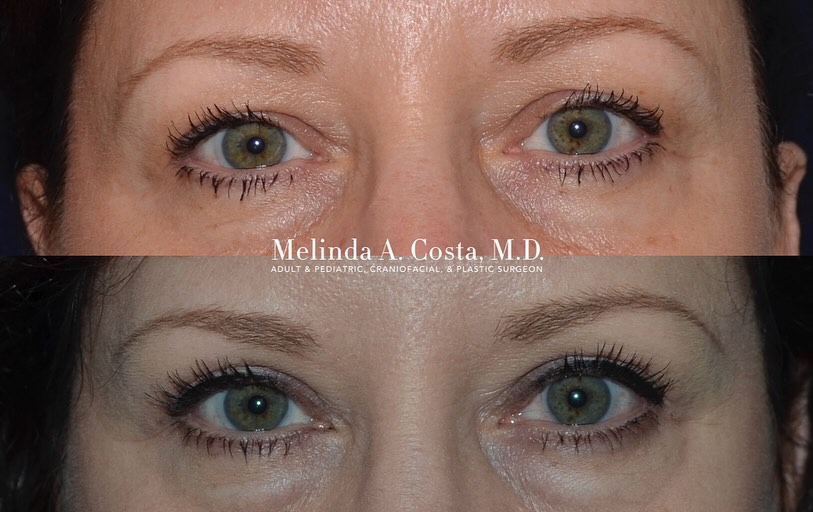 Instagram post by Dr. Melinda A. Costa: THE ART OF THE REFRESH Whether it’s the canvas or the OR, I focus on details that bring the face to life. An upper blepharoplasty, or eyelid…