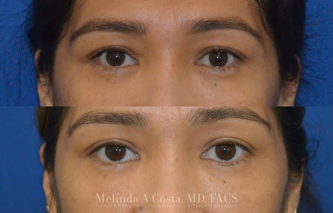 Instagram post by Dr. Melinda A. Costa: This 44 year-old patient came in with concerns of facial hollowness and asymmetry, particularly in the lower eyelids and cheeks. She underwe…