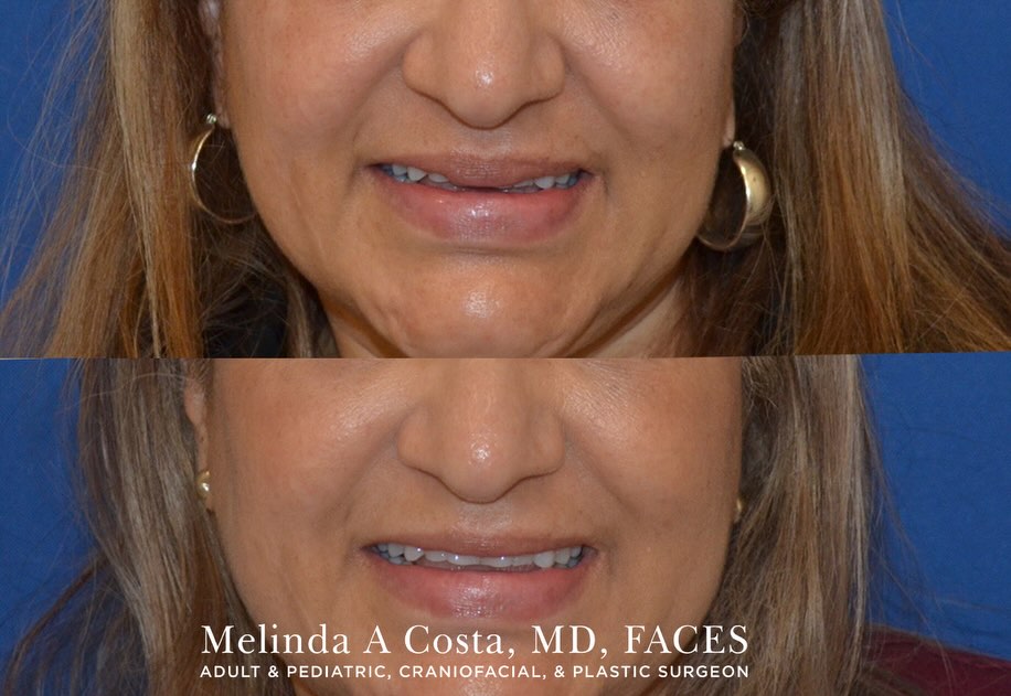 Instagram post by Dr. Melinda A. Costa: This 57 year-old patient presented with concerns from prior lip filler, including excess fullness in the central upper lip. She underwent li…