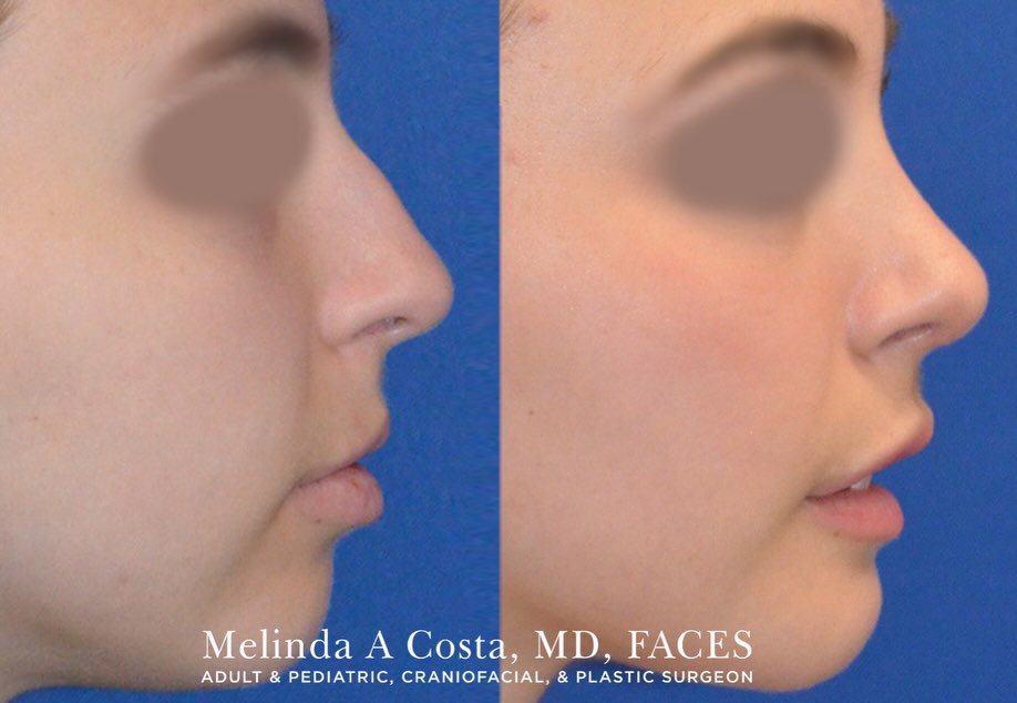Instagram post by Dr. Melinda A. Costa: This 22 year-old woman wanted a more defined profile, with increased chin projection and refined nasal shape. She underwent a rhinoplasty an…