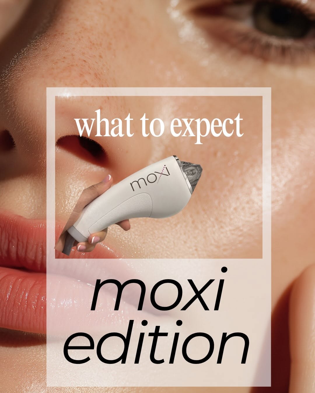 Instagram post by Dr. Melinda Haws: What to Expect: MOXI Edition ✨ Considering MOXI? Here’s your little peek at what happens before, during, and after treatment. From that warm…