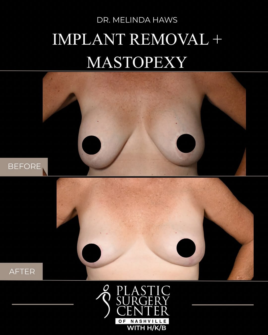 Instagram post by Dr. Melinda Haws: A fresh start after weight loss 🤍 After losing weight, this 51-year-old patient wanted to remove her implants and restore a lifted, more na…