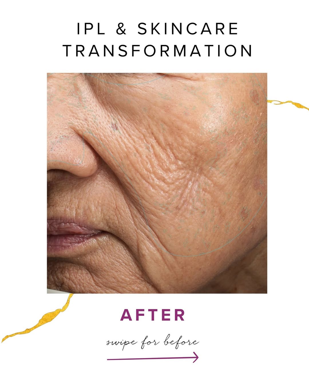 Instagram post by Dr. Melinda Menezes: IPL (intense pulsed light) paired with medical grade skincare can create visible improvements in clarity, tone, and fine lines. This combina…