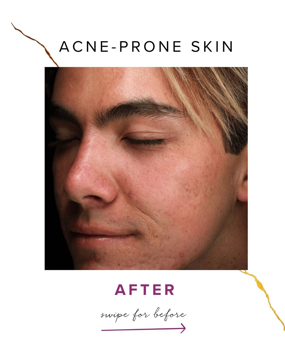 Instagram post by Dr. Melinda Menezes: Medical-grade skincare and microneedling can work together to support clearer, healthier skin. This combination helps refine texture and red…